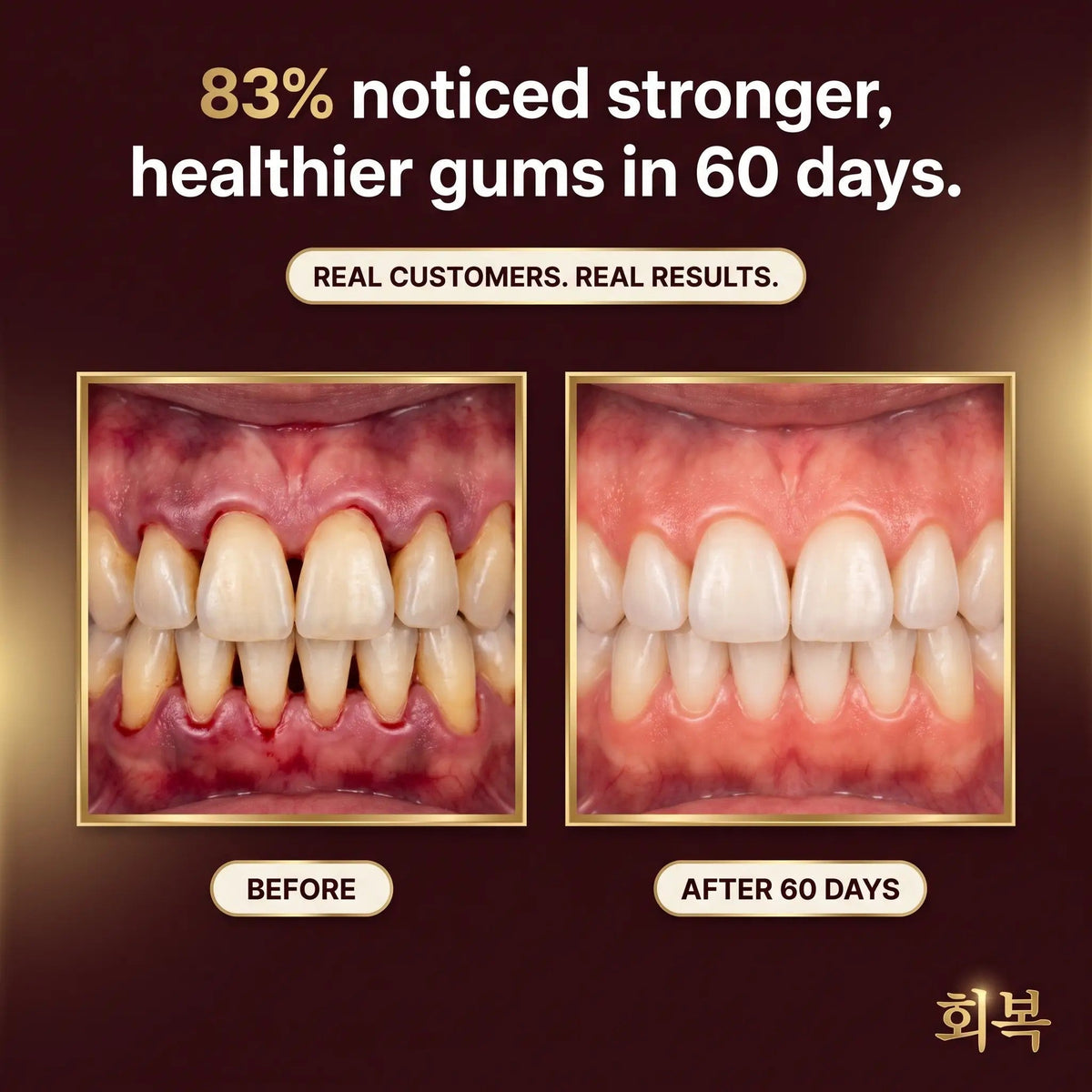 Gum Regrowth Armor（副本）